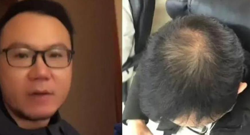 男子半年不用洗发水 秃顶变满头黑发